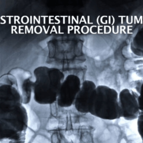 GI Tumor Removal Procedure