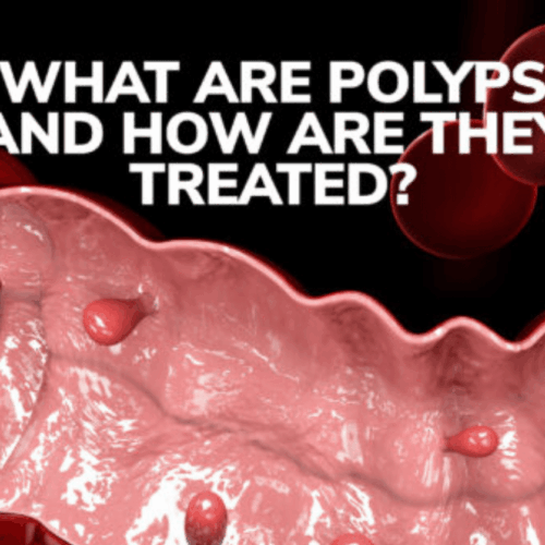 What Are Polyps and How Are They Treated?