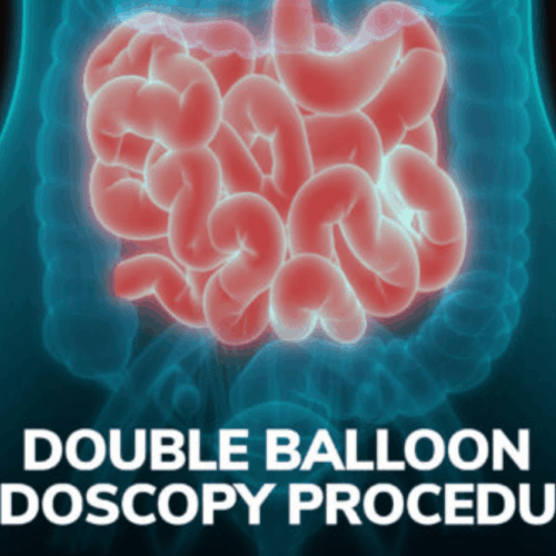 Double Balloon Endoscopy Procedure