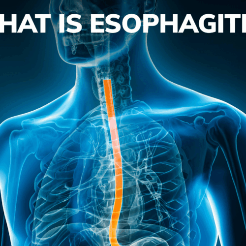 Esophagitis