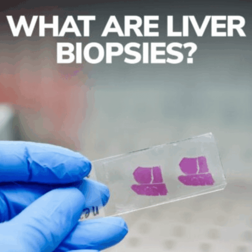 What are Liver Biopsies?
