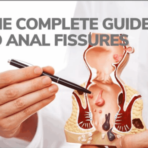 Anal Fissures