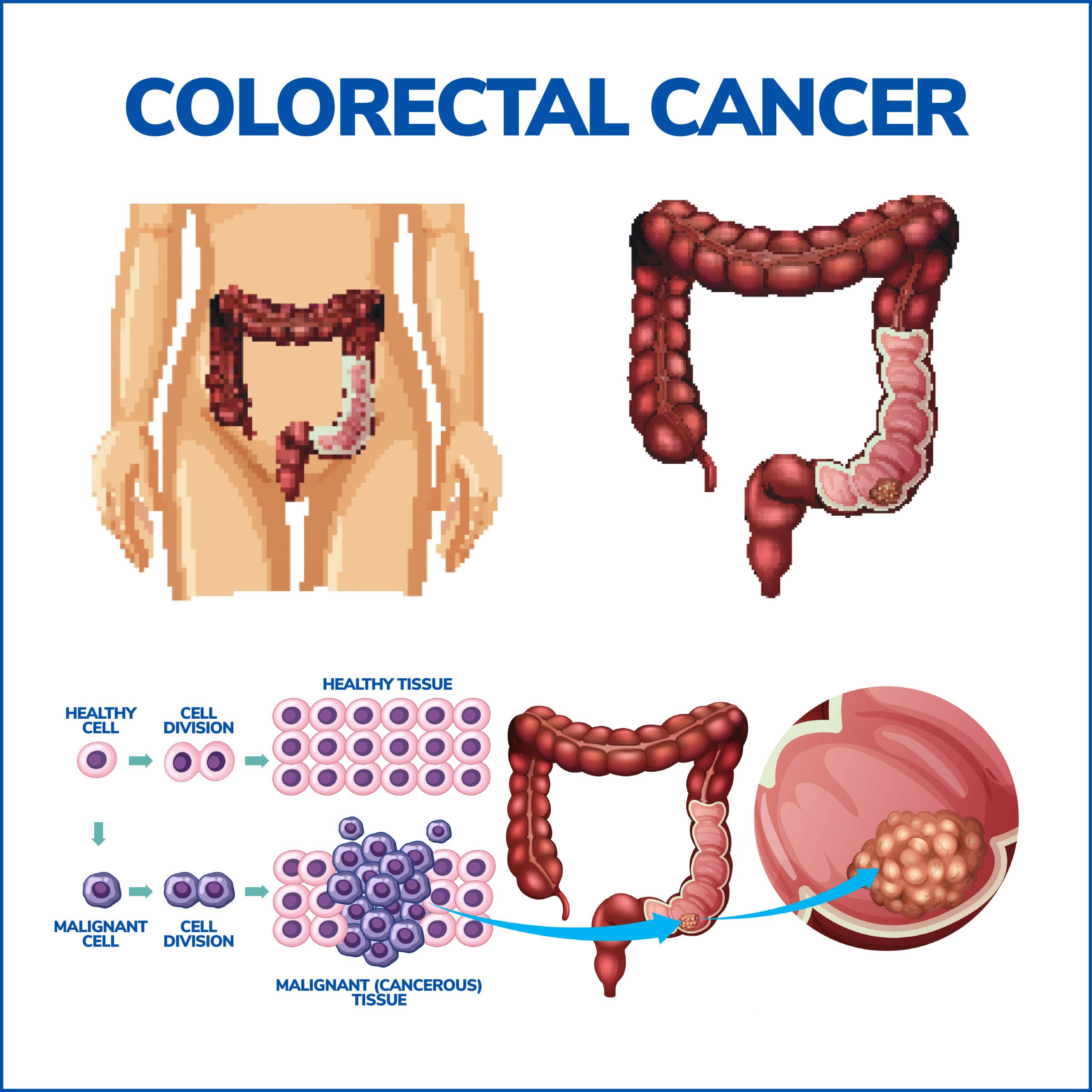 Colorectal Cancer