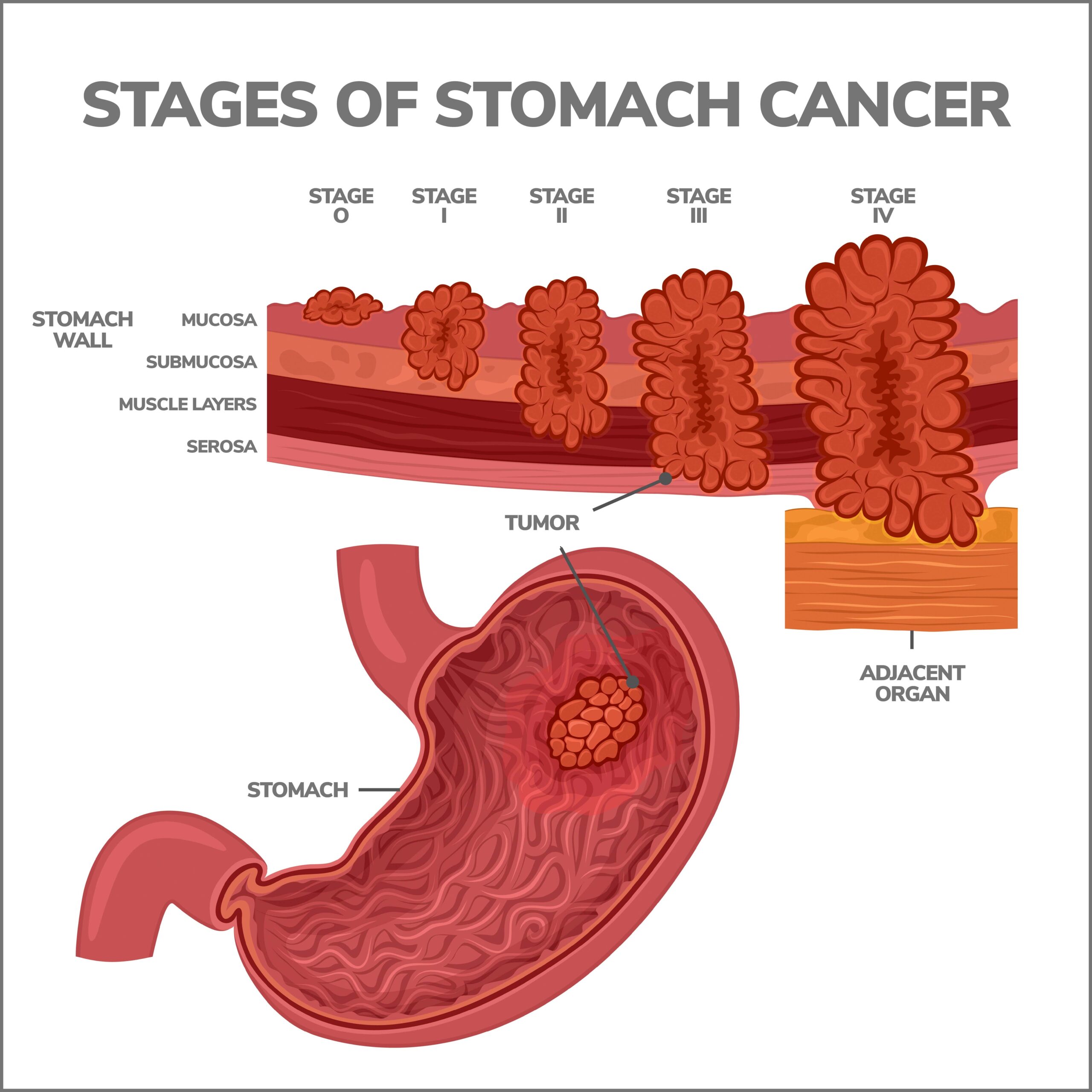 Comprender la progresión del cáncer de estómago: ¿A qué velocidad se propaga?