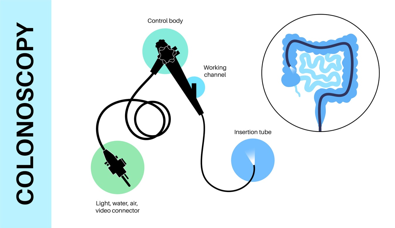 Graphic of a colonoscopy procedure