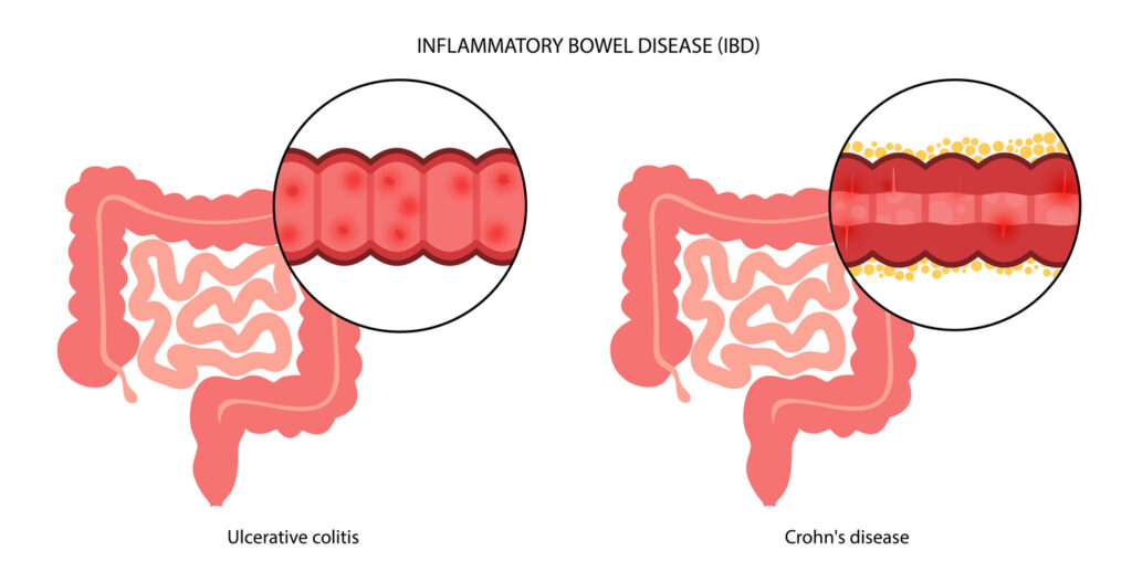Runner's Colitis Crohn’s vs. Colitis: Understanding Symptoms, Causes, and Treatment for ...